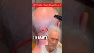 IMPOSSIBLE Hair Transplant 11k Grafts