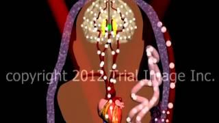 Hypoxic Ischemic Encephalopathy (HIE)  video - Animation by Cal Shipley, M.D.