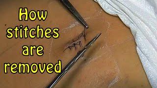 How stitches are removed #how