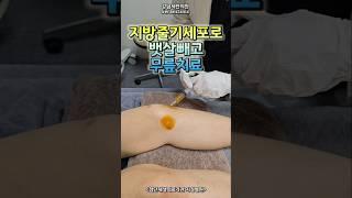 #무릎퇴행성관절염 #무릎통증 #연골손상  #줄기세포무릎주사