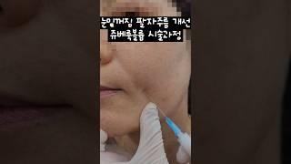 중안부 주름고민 얘기하시는 환자분 쥬베룩볼륨 시술과정 #injection #dermatology