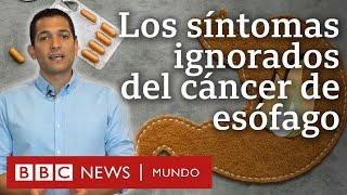 Cuáles son los síntomas del cáncer de esófago y por qué no debemos ignorarlos | BBC Mundo