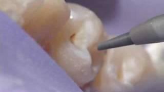 Dental Air Abrasion - Denville, NJ