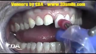 A Video of Prepless Dental Veneers Procedure at Cosmetic Dental Associates San Antonio, TX