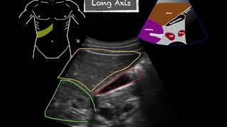 POCUS - Gallbladder Ultrasound Anatomy