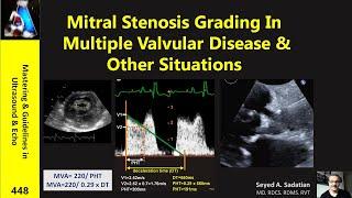 Mitral Stenosis Grading In Multiple Valvular Disease & Other Situations