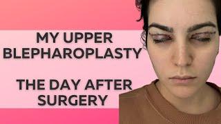 UPPER BLEPHAROPLASTY - PART 1 VLOG (WHAT HAPPENED DURING SURGERY)