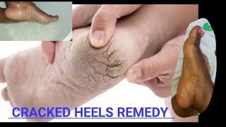 BEST FOOT SCRUBBING AT HOME TO AVOID CRACKED HEELS#diypedicureathome #crackedheelshomeremedy