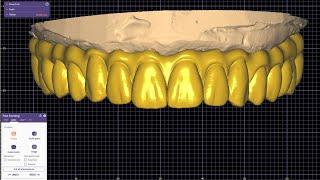 dental full arch @exocad @galway with gingiva as pontics   Mr. Walid Mansour 00201005587414    Egypt