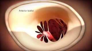 Minimally Invasive Robotic Mitral Valve Repair Animation