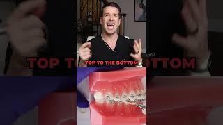 Braces Rubber Bands You Need to Know