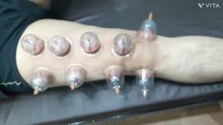 Patient had both right thighs front & back pain treatment for wet cupping hijama therapy Raichur