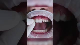 10 x UPPER VENEERME 