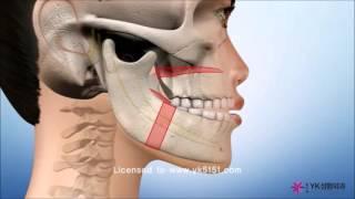 two jaw surgery, bimaxillary surgery, lefort, SSRO, 양악