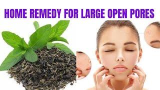 EASY METHOD TO GET RID OF FACE LARGE OPEN PORES(ಮುಖದ ಮೇಲಿನ ಓಪನ್ ಪೋರ್ಸ್ ಗೆ ಸುಲಭ ಪರಿಹಾರ)