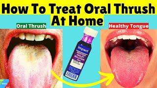 How To Treat Oral Thrush At Home | How to Treat Candida at Home