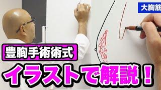 豊胸手術術式イラストで解説【教えて麻生先生】