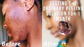 The ordinary peeling solution 4 weeks review with (before & after) tik tok made me do it