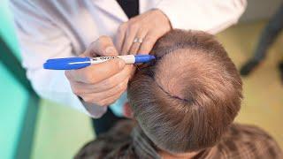 Haartransplantation in der Türkei: Bio Hair Clinic