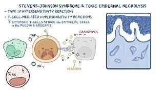 史帝芬強森症候群(steven johnson syndrome)