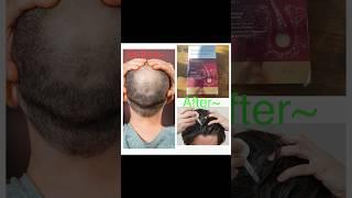 Tinfal minoxidil 5 uses  / leeford / tinfal for baldness /ganjepan ki medicine / #shorts