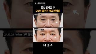 하안검수술, 중안면거상을 대표원장이 직접 받아봤습니다 (+눈밑지방재배치)