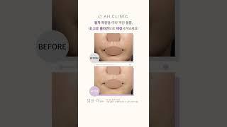 입가주름, 내 고유 콜라겐으로 재생시켜보세요!