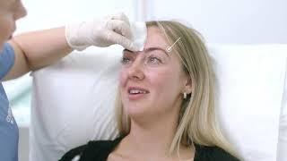 Preventative BOTOX treatment demo and results photos