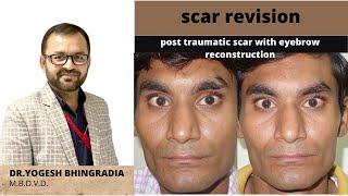POST TRAUMATIC SCAR | SCAR REVISION WITH EYEBROW RECONSTRUCTION | DR YOGESH BHINGRADIA