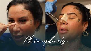 Yasmin's Rhinoplasty Surgery | MedAway