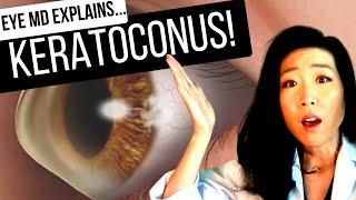 KERATOCONUS and What To Do About It | All About Cornea Cross-linking!