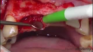 Ridge Augmentation using Tent Screw, Titanium Mesh and Bone Collector