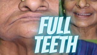 Full mouth dental implants cost in Chennai | Teeth Implant Cost in India | Dr.MKP