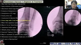 487.(의사용. Maisonneuve fx. 1:5~9) Diagnosis & Treatment. 메종노브 골절: 진단과 치료 [강찬.정형외과.충남대병원.Chan KANG]