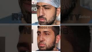 Rhinoplasty in Ludhiana | Nose Jobs Punjab | Dr Vikas Gawri #shorts