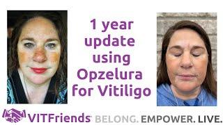 1 year using Opzelura for Vitiligo and a new development!