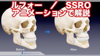 上下顎骨切り術、両顎手術、ルフォー、SSRO（下顎分割矢状骨切り術）についてわかりやすくアニメーションで紹介