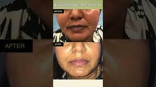 Instant Fairness  with Glutathione Treatment | Get Fair Skin Instantly & Permanently
