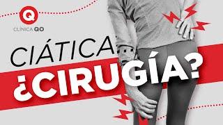 CIÁTICA ¿Cuál es la Causa y necesito Cirugía?