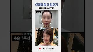 강남12 실리프팅 리얼 후기