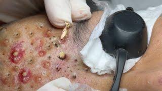 Loan Nguyen Acne Treatment 91e