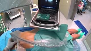 THORACIC T7 DRG Pulsed RF Ultrasound Guided