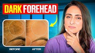 How to treat dark forehead | Causes | Prevention | Dermatologist suggests