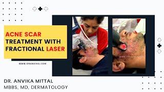 Acne Scar Treatment with Fractional Laser | Dermatologist | Dr Anvika Mittal | FRACTIONAL CO2 LASER