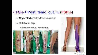 88.(의사용.Lecture) US-guided NB in Lower extremity 4/6. 수술 종류에 따른 신경차단술 조합(16분) [강찬.충남대.Chan KANG]