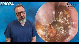 Irritated Ear Canal Wax Removal - EP1024