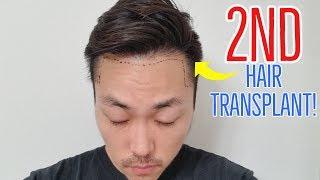 IM GETTING A 2ND HAIR TRANSPLANT IN 2019!