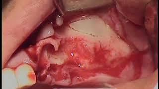 바이오템 임플란트 임상자료 20151130_3 (Biotem Implant Clinical Data 20151130_3)