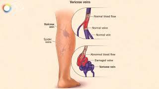 Laser and RFA treatment for varicose veins: Dr Solanki, General surgeon, TaCa Centre For Surgery