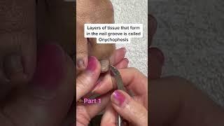 Do I have an ingrown toenail? Part 1. #ingrowntoenail #nailproblemsolution #satisfying #pedicure